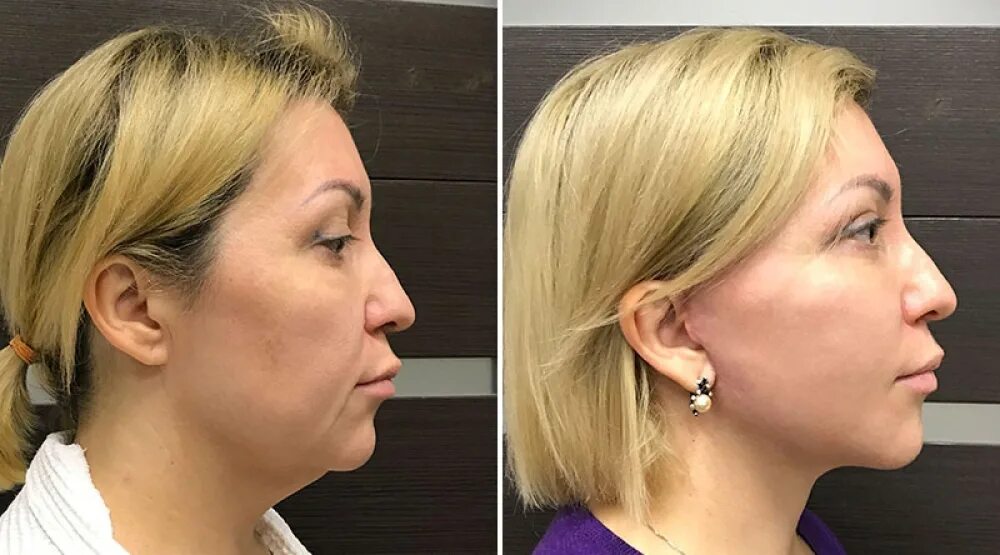 Николаенко андрей антонович хирург. Эндоскопическая подтяжка лица. Атаманов хирург новосибирск. Пластика верхних век (верхняя блефаропластика) (2 схема). Пластическая операция на нос.