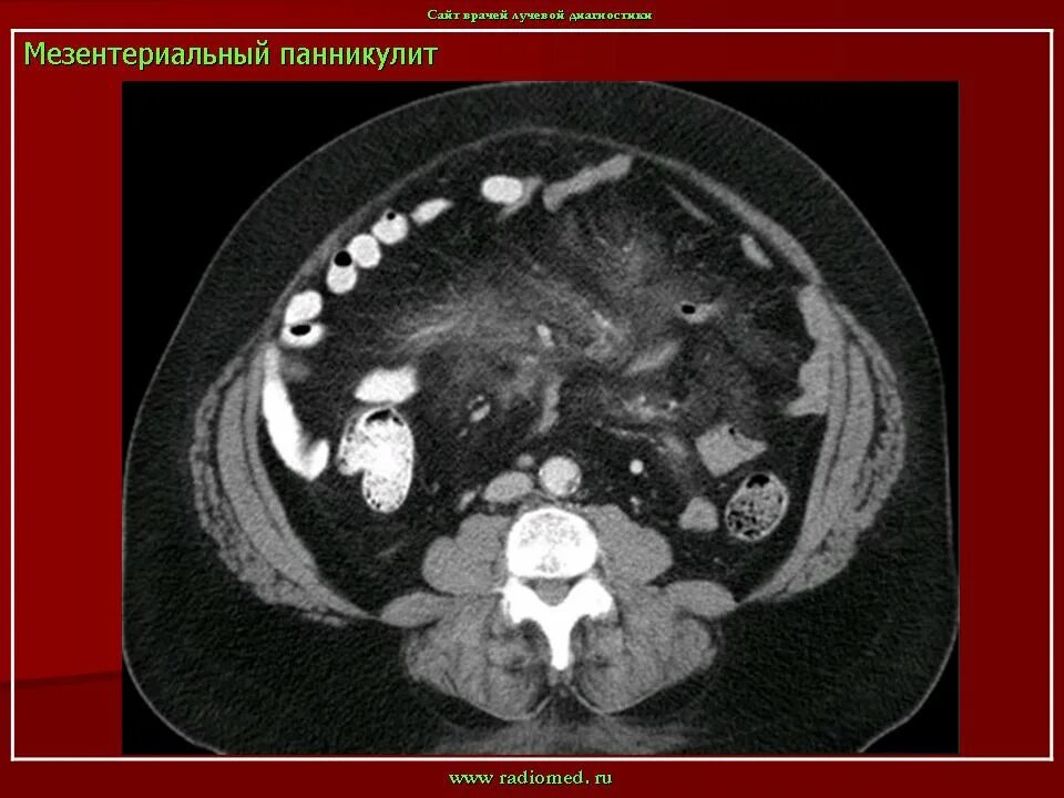 Лимфома брюшной. Панникулит брыжейки кт. Мезентериальный панникулит на кт. Инфильтрация брыжейки на кт.