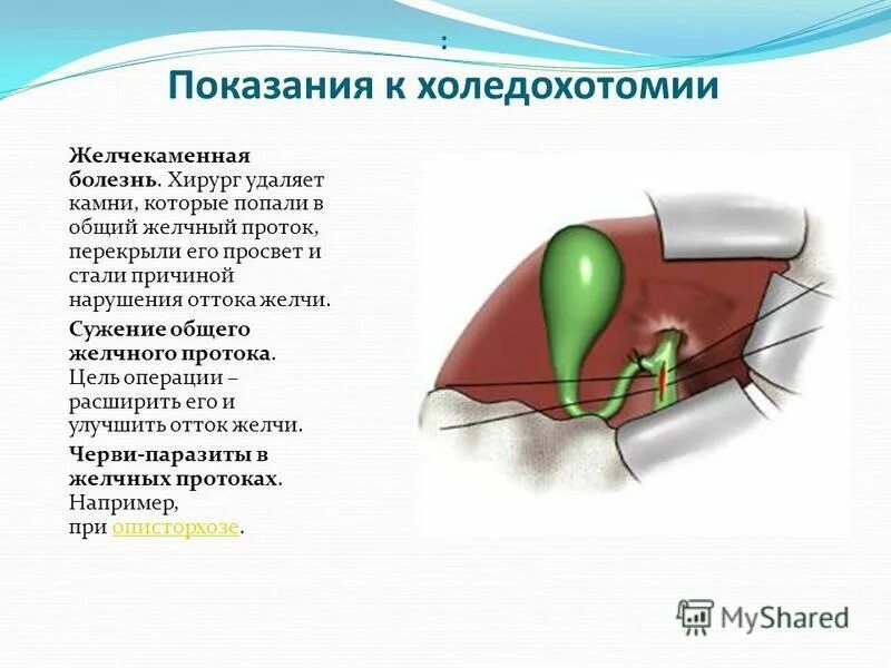 Удаление желчного пузыря отзывы врачей