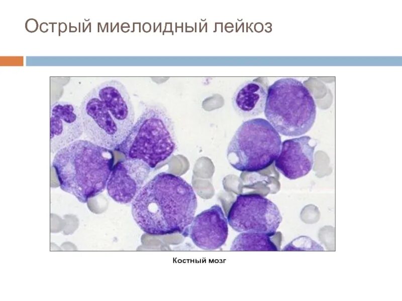 Острый миелоидный лейкоз прогноз. Острый миелобластный лейкоз. Острый миелоидный лейкоз клиническая картина. Острый лейкоз костный мозг. Картина крови при миелобластном лейкозе.