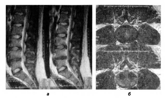 Протрузии межпозвонковых дисков l4 s1. Протрузия мрт. Протрузия дисков позвоночника мрт. Выпрямление шейного лордоза мрт. Межпозвоночная грыжа 7мм.