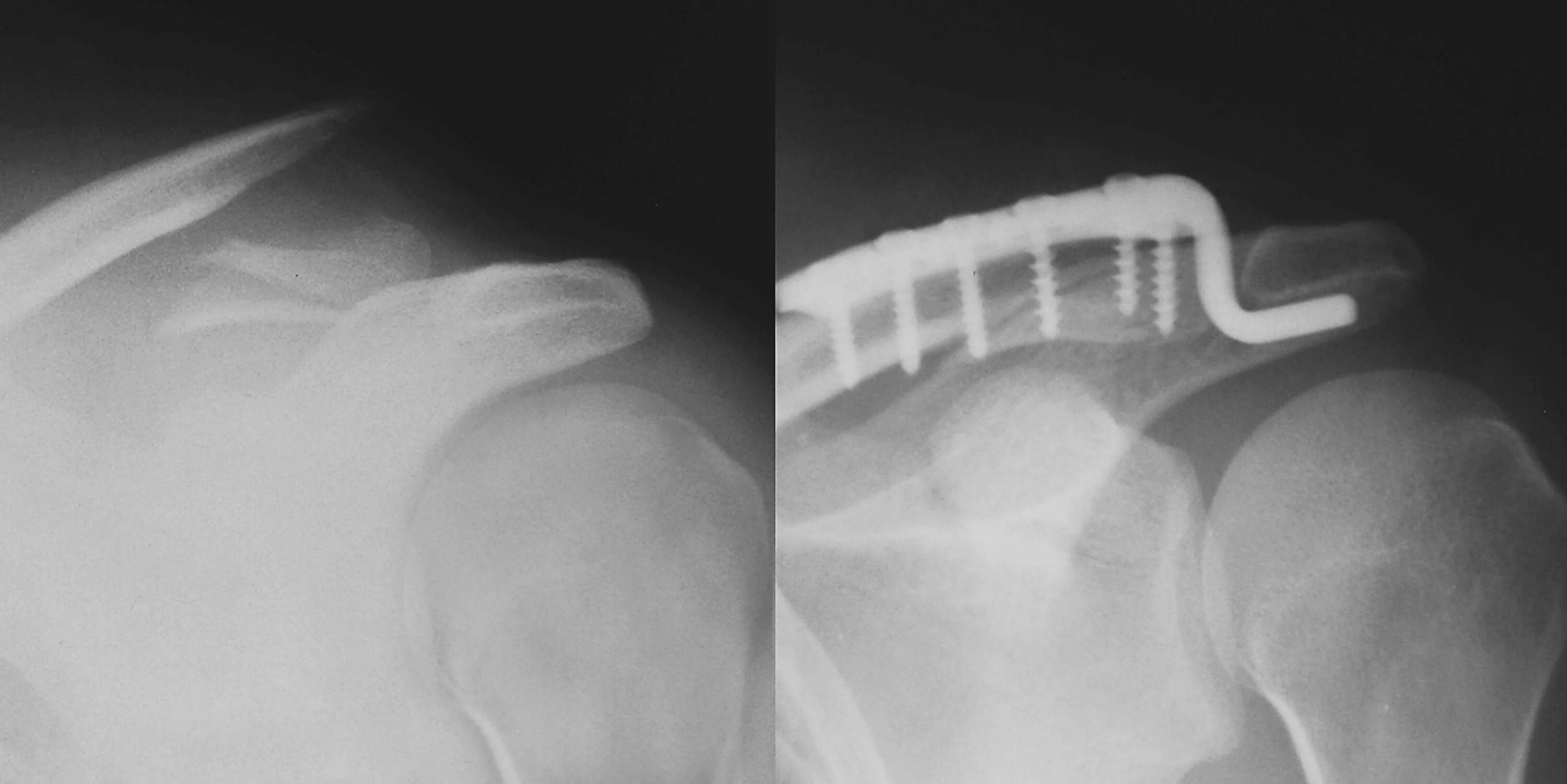 Акромиальный перелом ключицы рентген. Акромиальный вывих ключицы рентген. Перелом акромиального конца ключицы. Вывих акромиального конца ключицы рентген. Перелом плеча пластина