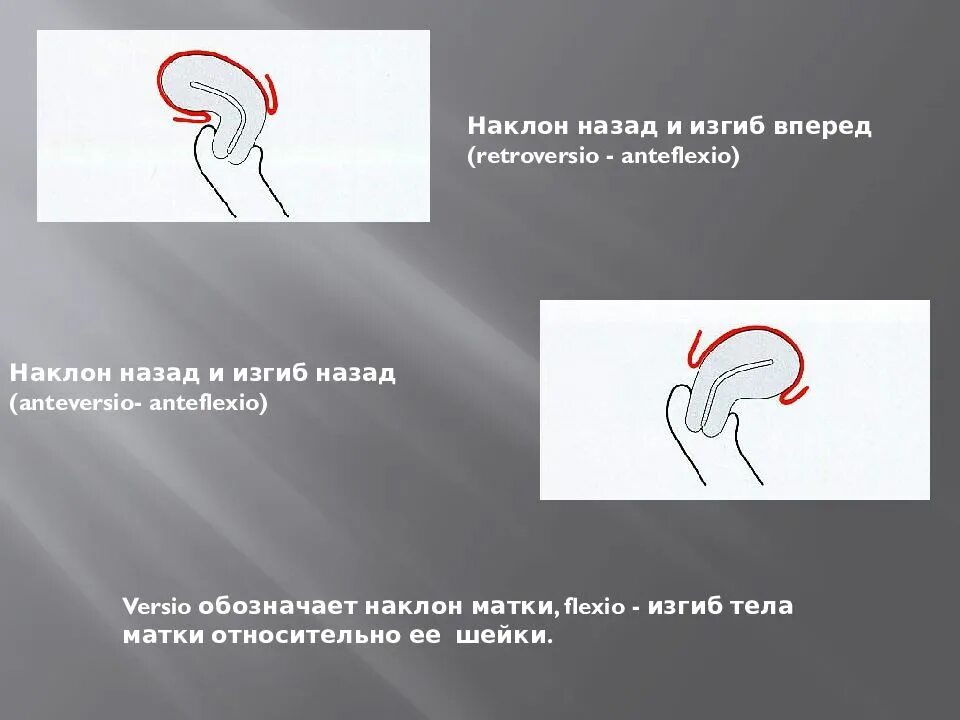 Положение матки. Антеверзио антефлексио. антефлексия и антеверсия матки. антефлексио положение матки что это. anteversio anteflexio матки что это.