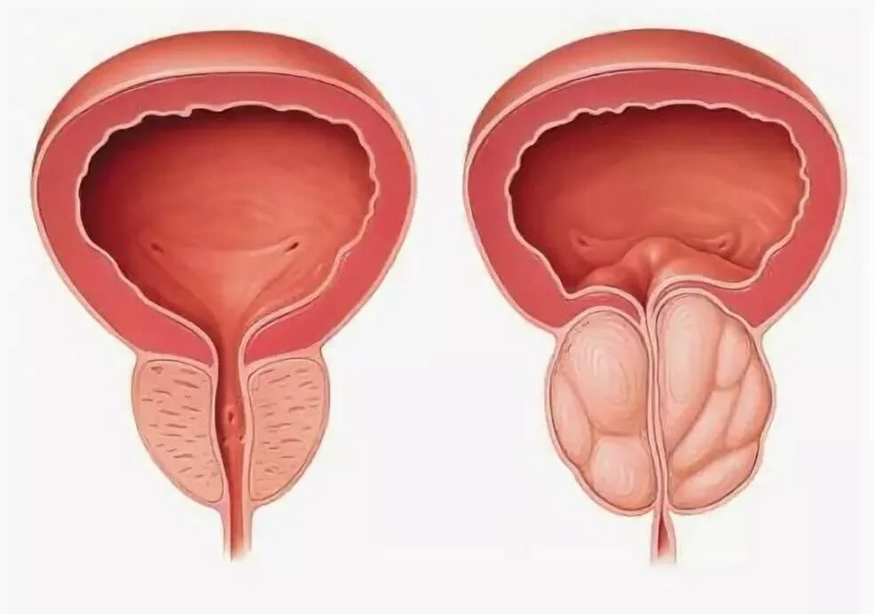Воспаление предстательной железы. Простата это предстательная