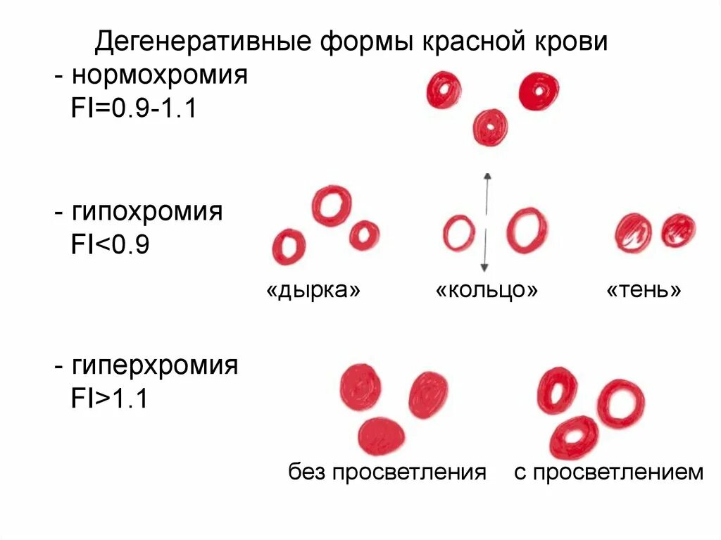 Анемия крови что это. Гипохромная анемия показатели. Нормохромная гипохромная гиперхромная анемия. Гиперхромия эритроцитов в крови. Гипохромные нормохромные гиперхромные эритроциты.