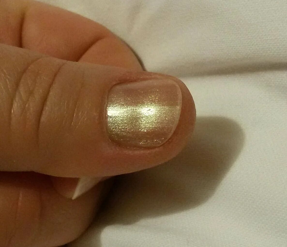 Беспигментная подногтевая меланома. Вмятина на ногте большого пальца.