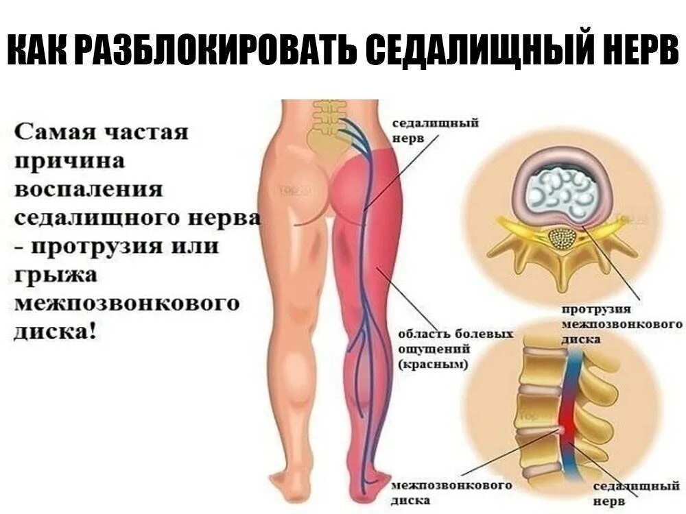 Может ли при грыже быть температура
