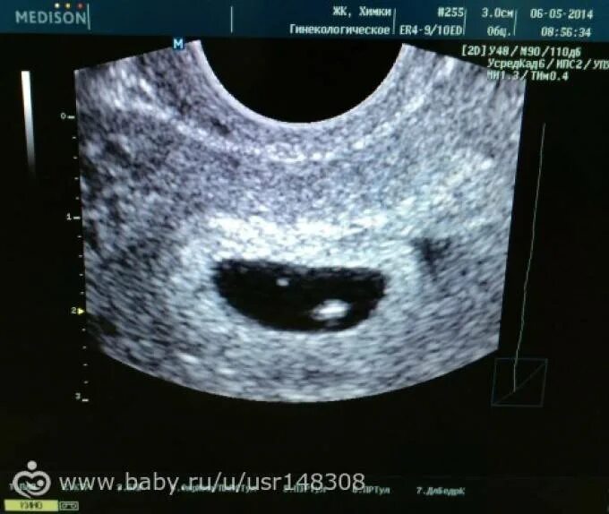 Анэмбриония  6,5 недель беременности. УЗИ 8 недель беременности анэмбриония. Анэмбриония – пустое плодное яйцо. Без плодного яйца