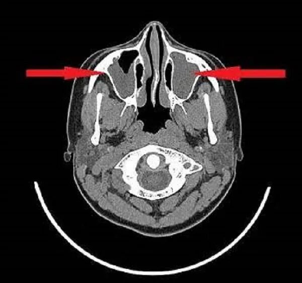 Признаки сфеноидита. Сфеноидальный синусит. Сфеноидит на кт. Кт снимок пазух носа сфеноидит.