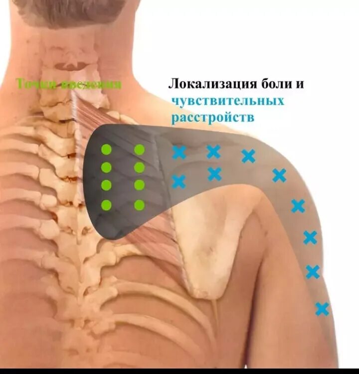 Паравертебральная блокада поясничного отдела позвоночника. Блокада триггерных точек шейного отдела. Точки блокады позвоночника. Точки блокады плечевого сустава.