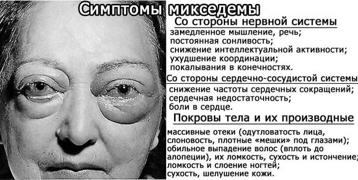 Симптомы заболевания микседема.