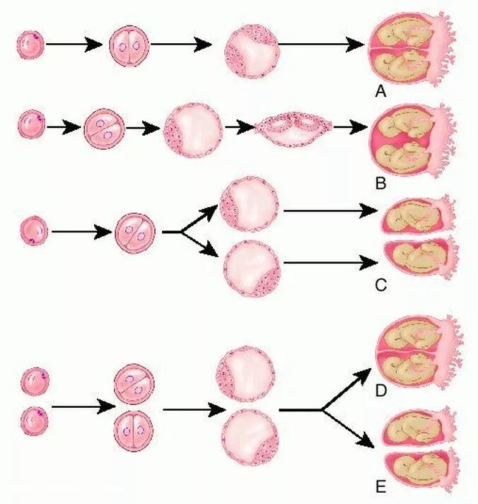 Типы внутриутробного развития многоплодной беременности. Дизиготная многоплодная беременность. Монохориальная моноамниотическая многоплодная беременность. Этапы развития эмбриона по неделям. Оплодотворение близнецов и двойняшек.
