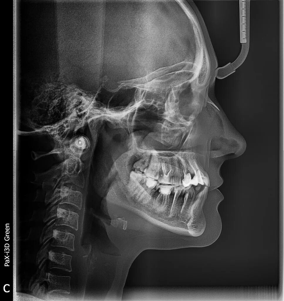 Снимок. Телерентгенограмма (ТРГ). ТРГ черепа в боковой проекции.