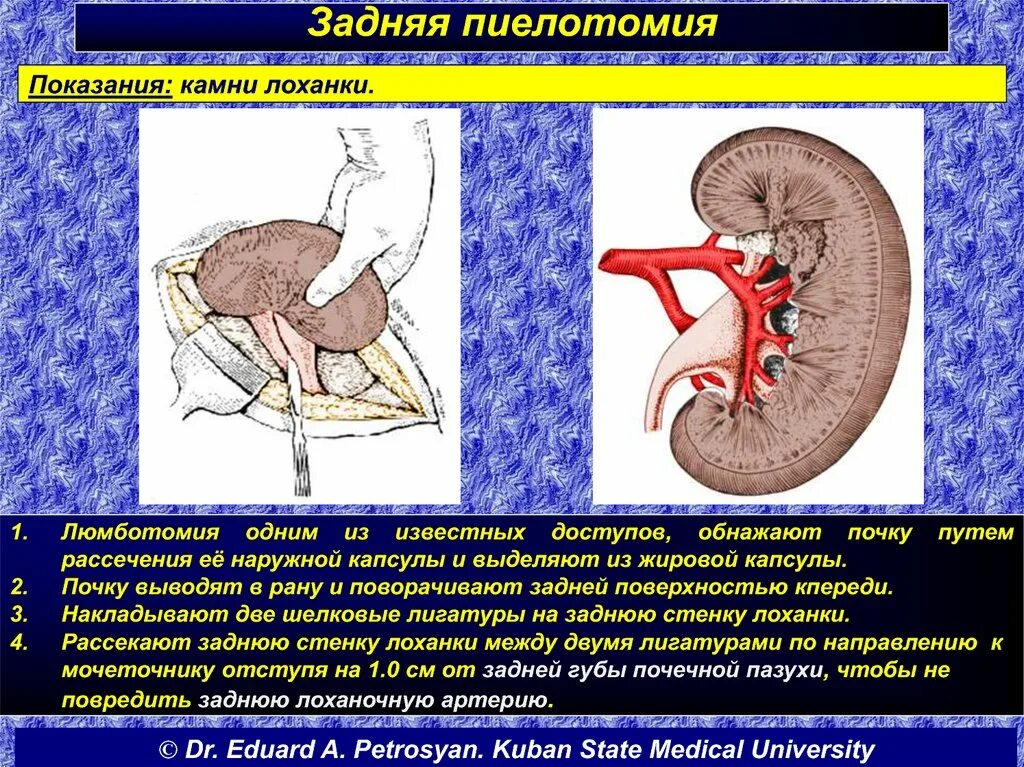 Резекция почки что это. Операции на почечной лоханке топографическая анатомия.