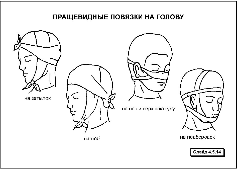 Пращевидная повязка на затылок. Схема наложения пращевидной повязки. Повязка при повреждении лба. Пращевидная повязка на лоб.