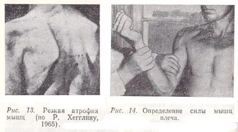 Мышечная дистрофия дрейфуса