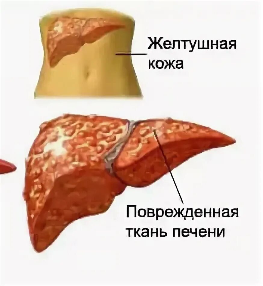 Проблема печени у женщин. Воспалительное поражение печени.