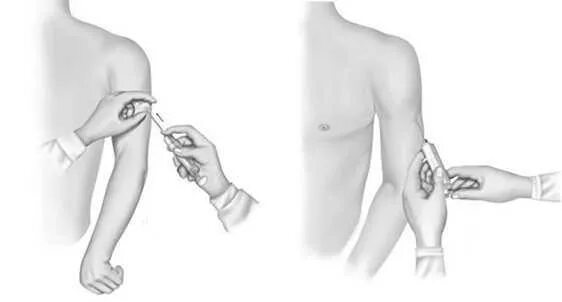 Подкожная инъекция в плечо техника. Безредко Введение сыворотки. Подкожная инъекция в плечо алгоритм. Введение лекарства подкожно.