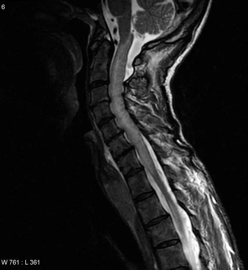 Сдавление спинного. Сифилис на мрт спинного мозга. Лимфома эпидурально сдавление спинного мозга. Limphoma Spinal Cord MRI.