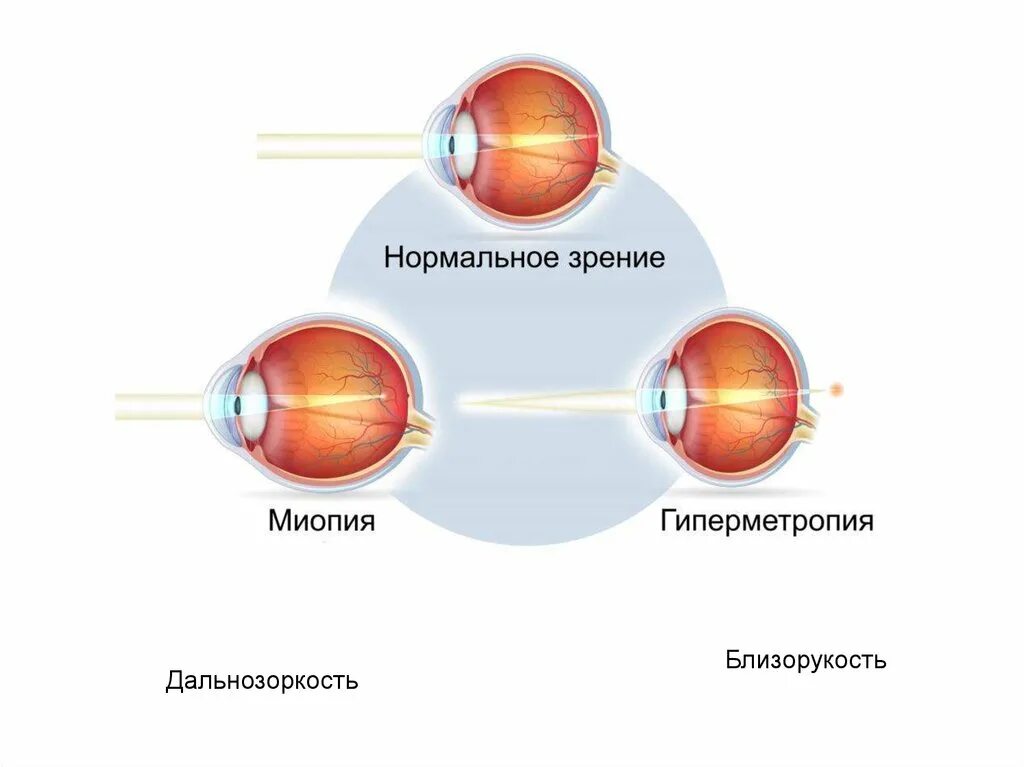 Близорукость строение глаза. Дальнозоркость и близорукость строение глаза. Близорукость позади сетчатки. Удлинение глазного яблока при близорукости. Перед сетчаткой расположена