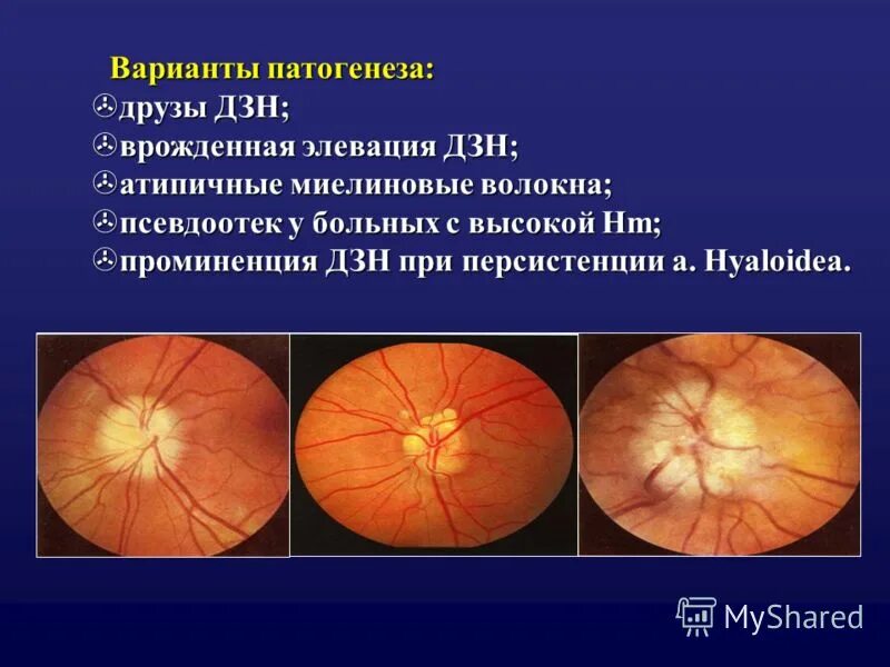 Аномалия развития зрительного нерва. Миелиновые нервные волокна ДЗН. Глазное дно миелиновые волокна. Друзи диск зрительного нерва.