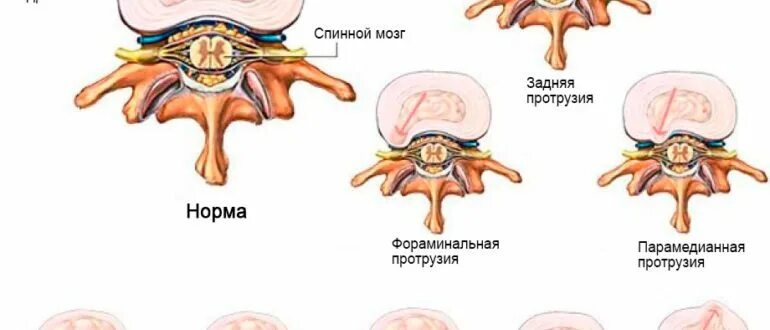 Задняя протрузия диска l5. Циркулярное выбухание диска l5-s1 что это. протрузия шейного отдела с4-с6. парамедианная фораминальная протрузия. диффузная протрузия диска l5-l6.