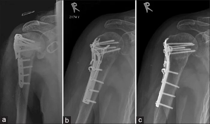 Перелом хирургической шейки плечевой кости рентген остеосинтез. Перелом хирургической шейки остеосинтез плечевой. Остиозинтес большого бугра п. Чрескостный остеосинтез плечевой кости. Перелом плеча пластина