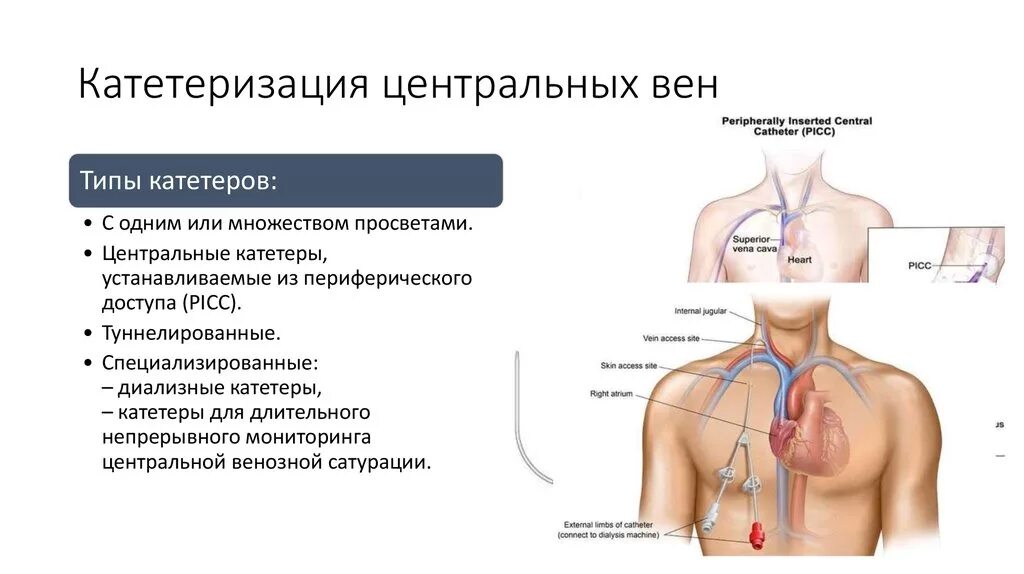 Подключичный тромбоз. Подключичный катетер кт контроль. Центральный венозный катетер подключичный. Центральный венозный катетер схема.