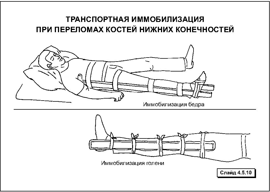 Открытый перелом бедра первая помощь. Транспортировка пострадавших при переломах верхних конечностей. Транспортировка пострадавшего при ранением конечностей. Транспортировка больного при переломе бедра. Иммобилизация пострадавшего при переломе нижних конечностей.