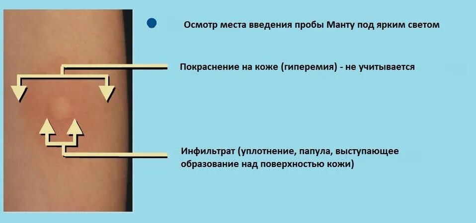 Манту размеры норма 6. Диаскинтест норма реакции у детей 7 лет. реакция на туберкулез диаскинтест. диаскинтест размеры норма. проба диаскинтест оценка результата у детей.