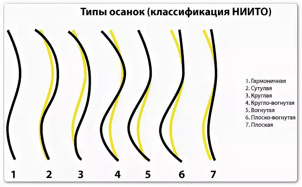 Три степени нарушения осанки. Таблица осанки. Нарушение осанки в сагиттальной плоскости и фронтальной. Сагиттальное искривление позвоночника. Типы нарушения осанки лордоз.