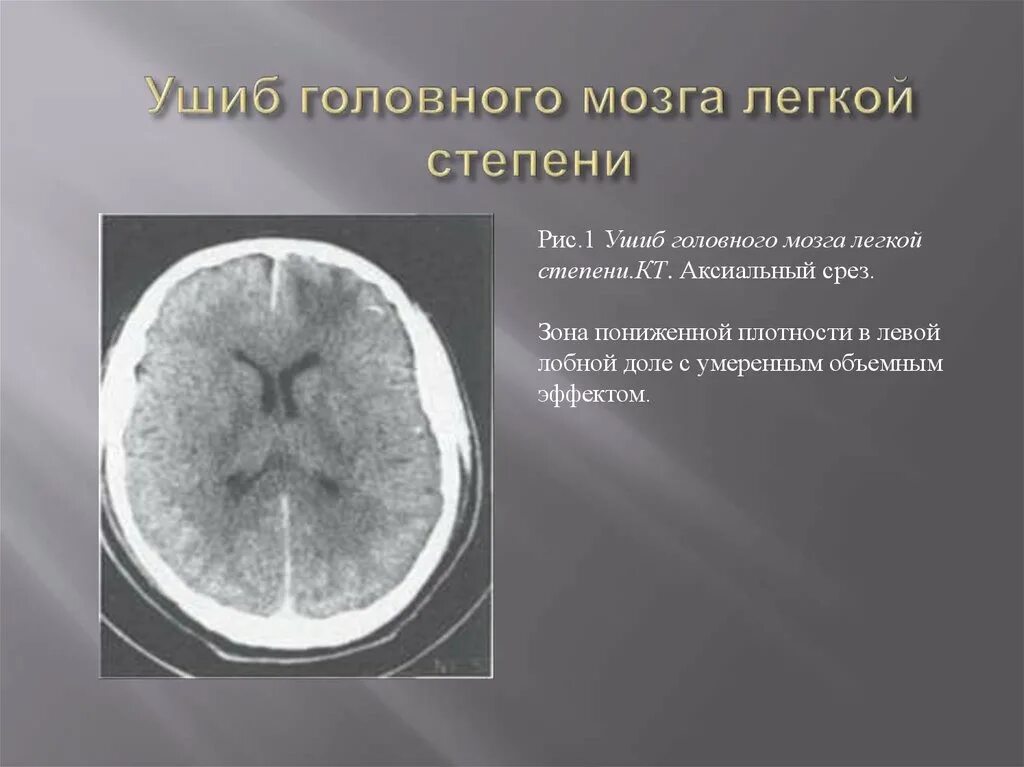 Ушиб головного мозга легкой степени кт. Ушиб головного мозга средней степени мрт. Ушиб головного мозга 1 степени. Ушиб головного мозга легкой степени тяжести кт.
