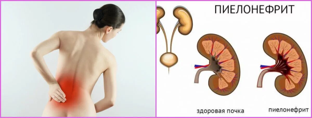 Почка человека симптомы. Болезнь почек пиелонефрит у женщин.