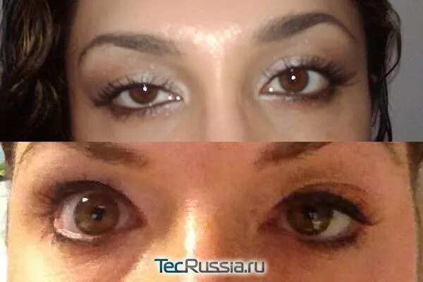 Опустились глаза после ботокса. Птоз верхнего века от ботокса. птоз верхнего века после ботулинотерапии. птоз нижнего века после ботокса.