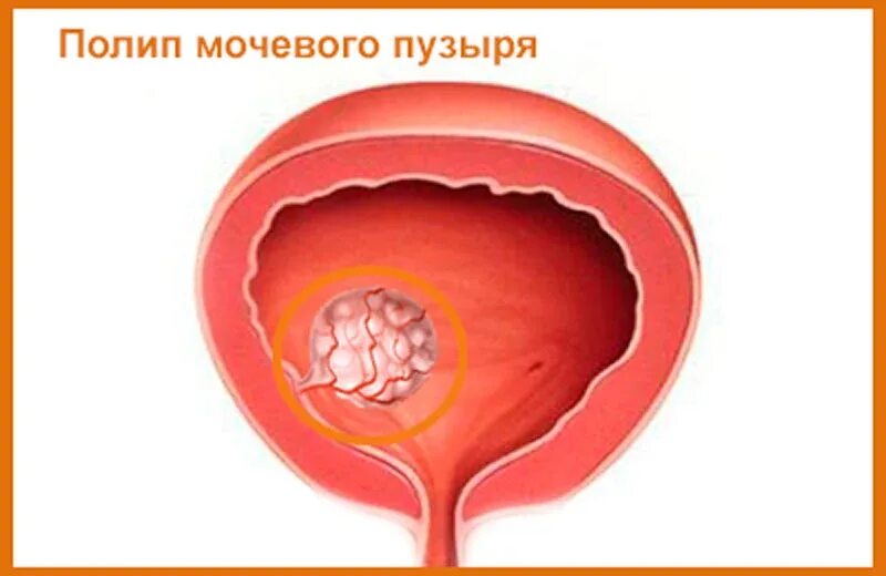 Болезнь мочевого пузыря у женщин лечение. Полиповидное образование мочевого пузыря. Папиллома мочевого пузыря.