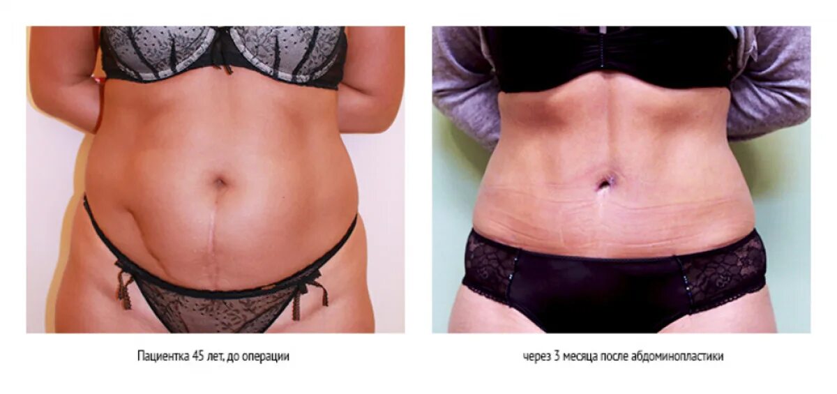 Абдоминопластика боков. Миниабдоминопластика (пластика живота). Абдоминопластика живота. Абдоминопластика реабилитация. Бандаж послеоперационный абдоминопластика.