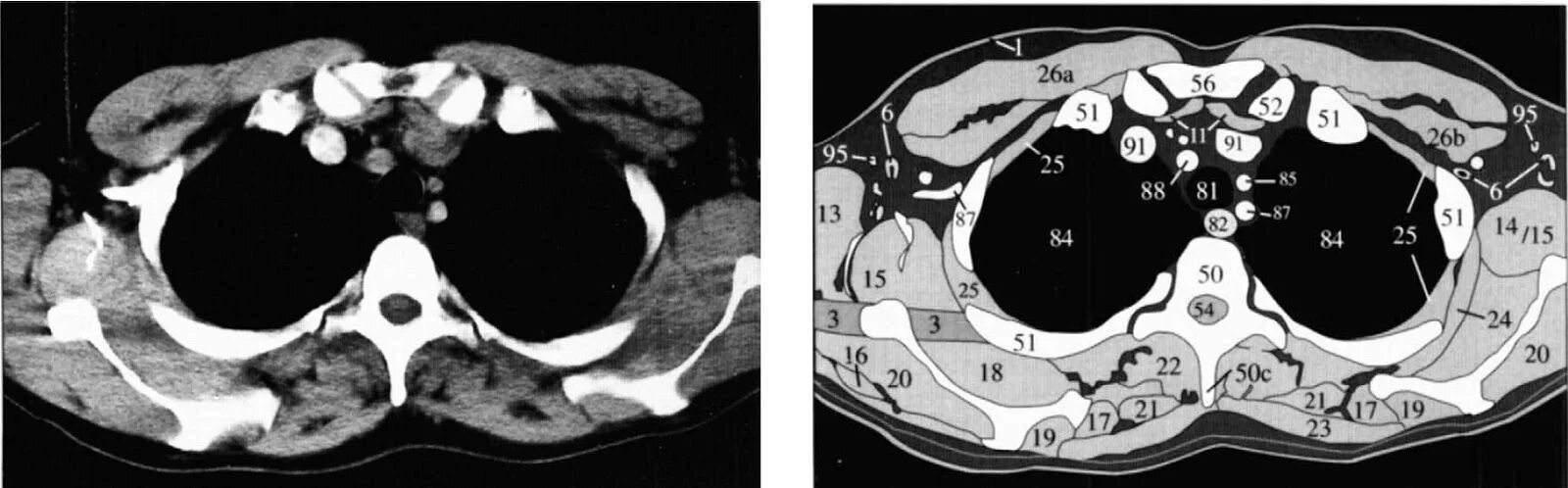 Срезы на кт легких. Поперечный срез кт. Кт органов грудной клетки. Компьютерная томография груди. Аксиальный срез кт легкие.