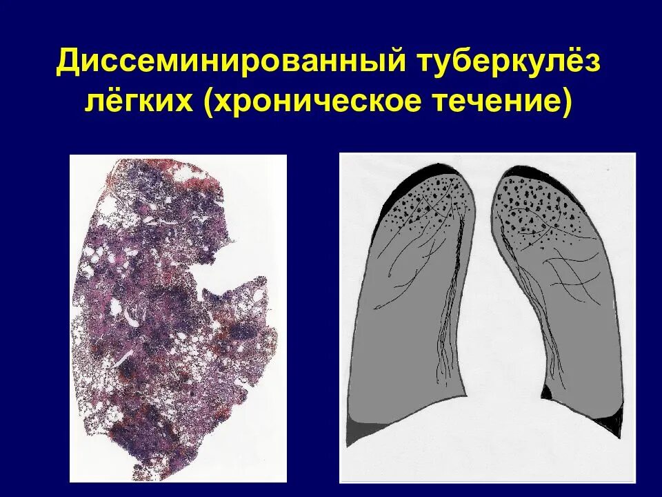 Ru туберкулез. Подострый диссеминированный туберкулез кт. Острый милиарный диссеминированный туберкулез. Диссеминир туберкулез легких. Подострый диссеминированный туберкулез легких.