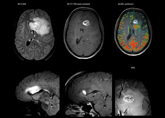 Глиобластома головного мозга на кт. Мультиформная глиобластома. Как выглядит глиобластома на мрт. Отек мозга глиобластома MRI Flair.
