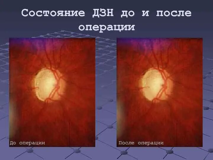 Бледные диски зрительных. Бледный диск зрительного нерва. субатрофия зрительного нерва. бледные диски зрительных нервов. бледности диска зрительного нерва с четкими границами.