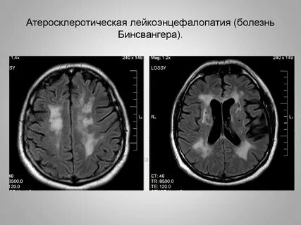 Что такое сосудистая энцефалопатия