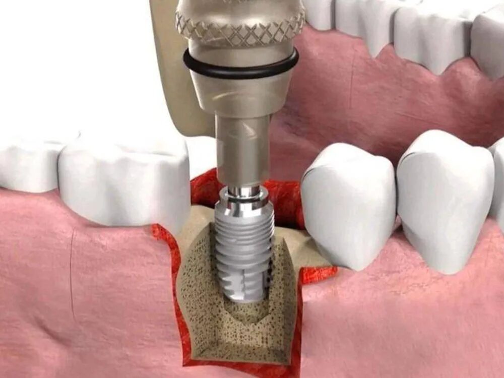Зубы импланты поэтапно. Имплантация NEOBIOTECH. Имплантация формирователь Osstem. Имплант Штрауман Tissue формирователь. Формирователь десны на имплант что такое.