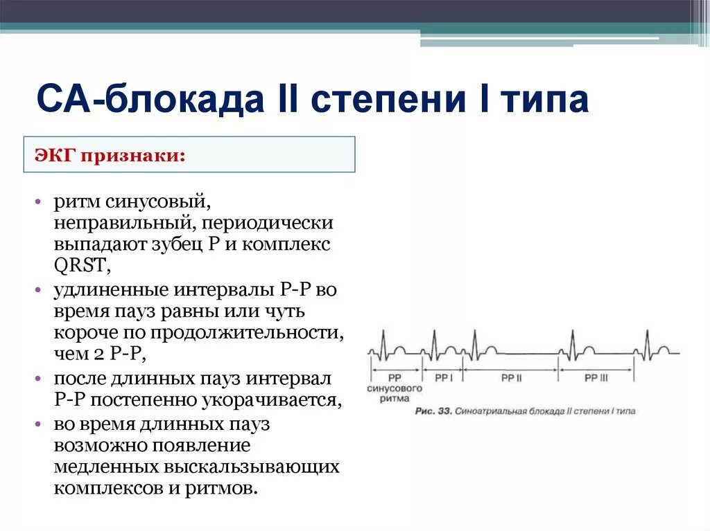 Са блокада 2 тип. Са блокада 2 степени 1 типа на ЭКГ. Синусовая блокада 2 степени ЭКГ. Са-блокада II степени, Тип 2 (Мобитц 2). Са блокада 2 степени Мобитц 1 на ЭКГ.