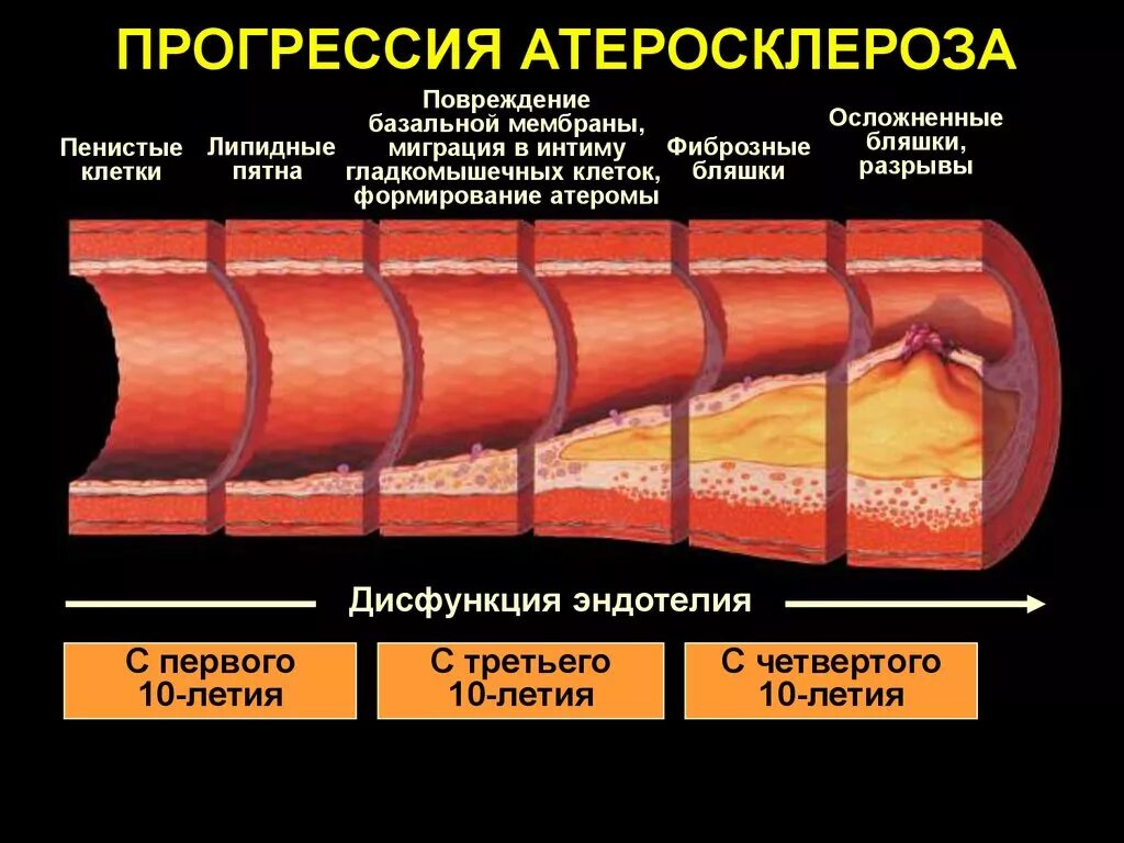 Атеросклеротические изменения сосудов. Механизм развития атеросклероза сосудов. Патогенез атеросклероза повреждение эндотелия. Стадии развития атеросклеротической бляшки. Этапы формирования атеросклеротической бляшки.