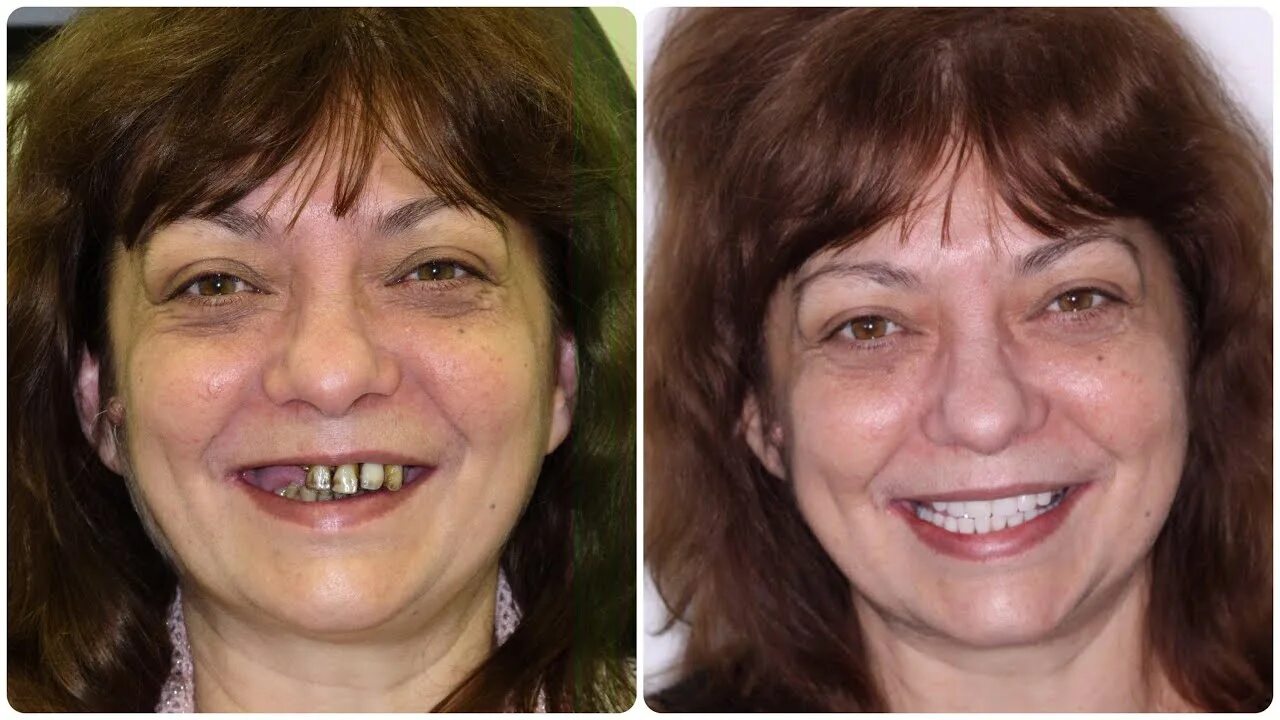 Зубные протезы до и после. Имплантация передних зубов. Имплантация зубов до и после. Установленных до и после