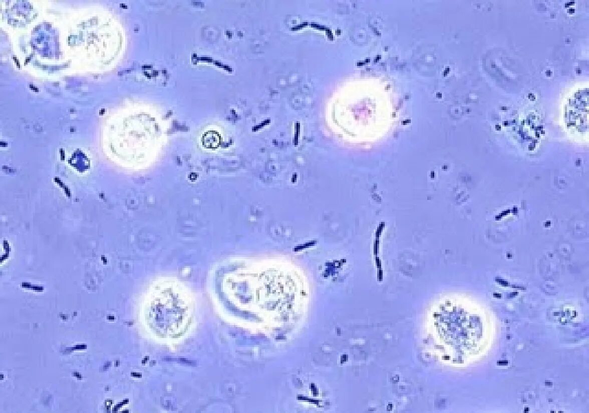 Бактерии в моче после лечения. Лейкоцитурия бактериурия. Микроскопия мочи бактерии. Бактерии в моче микроскопия. Бактериурия микроскопия.