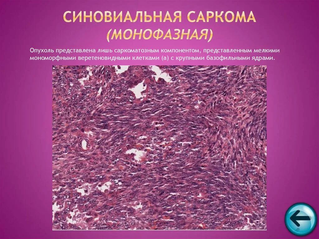 Гемангиоперицитома гистология. Монофазная синовиальная саркома. Синовиальная саркома гистология. Монофазная синовиальная саркома гистология. Злокачественная опухоль из соединительной