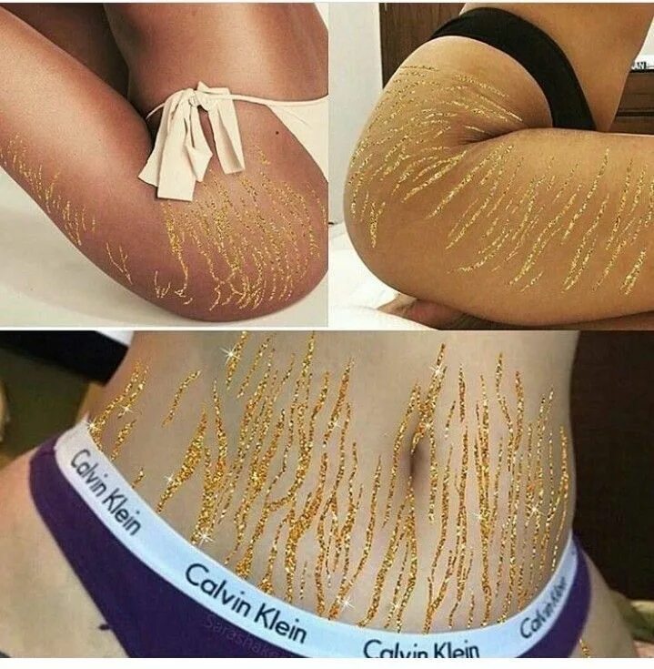 Растяжки stretch marks