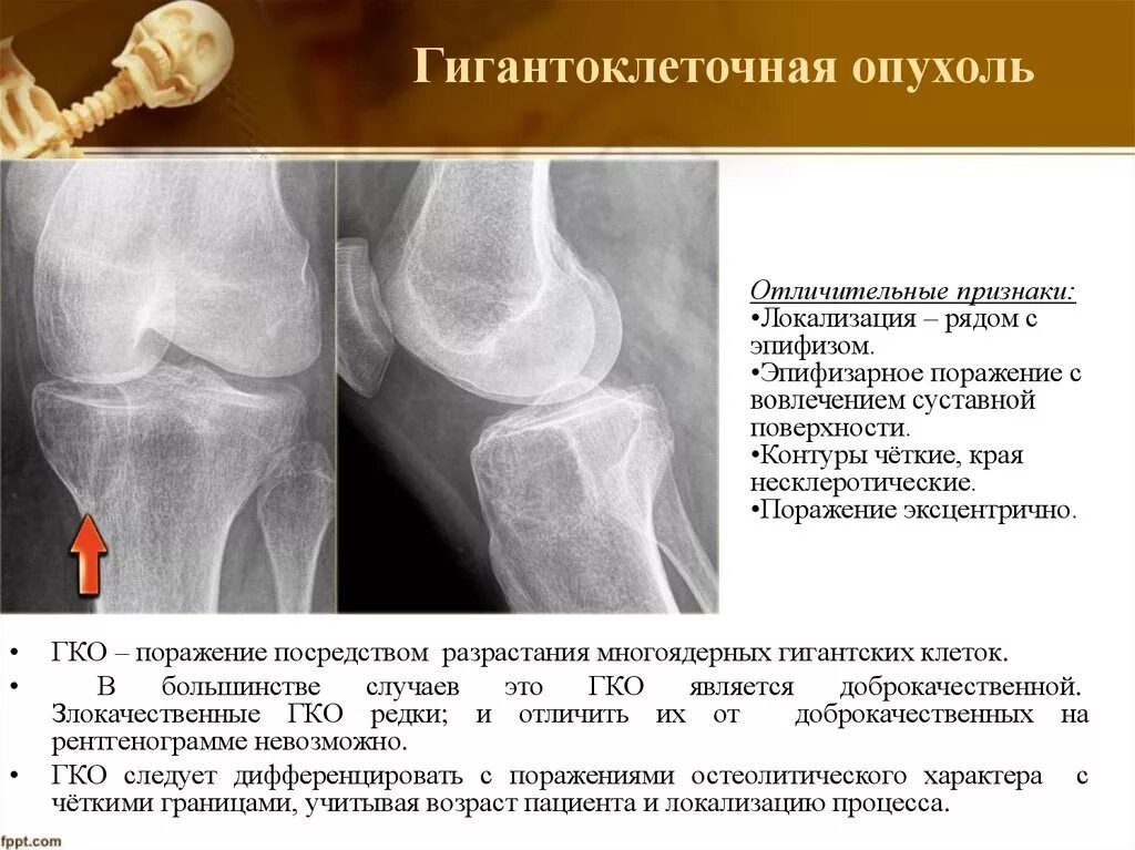 Гигантоклеточная опухоль бедренной кости рентген. Гигантоклеточная опухоль формы. Гигантоклеточная опухоль лечение. Гигантоклеточная опухоль кости рентген. Гигантоклеточная опухоль кости кт.