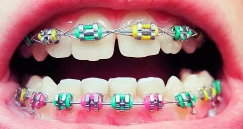 Какие лучше ставить резинки на брекеты